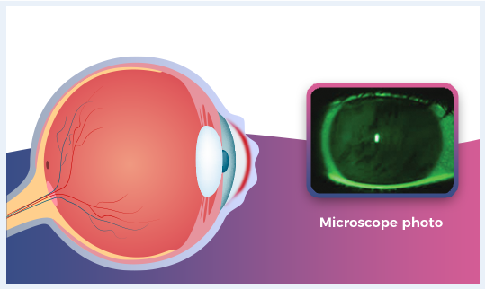 Dry eyes (Stable tear firm)